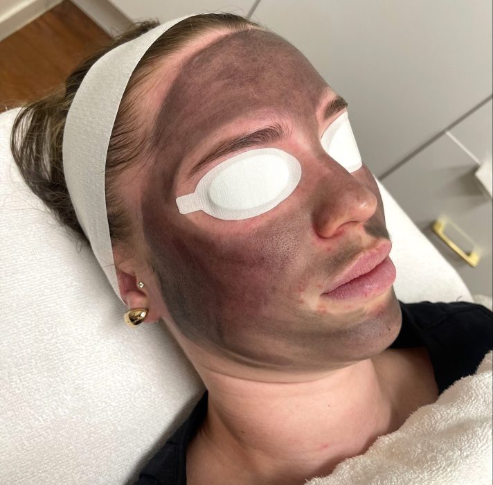 Carbon Facial